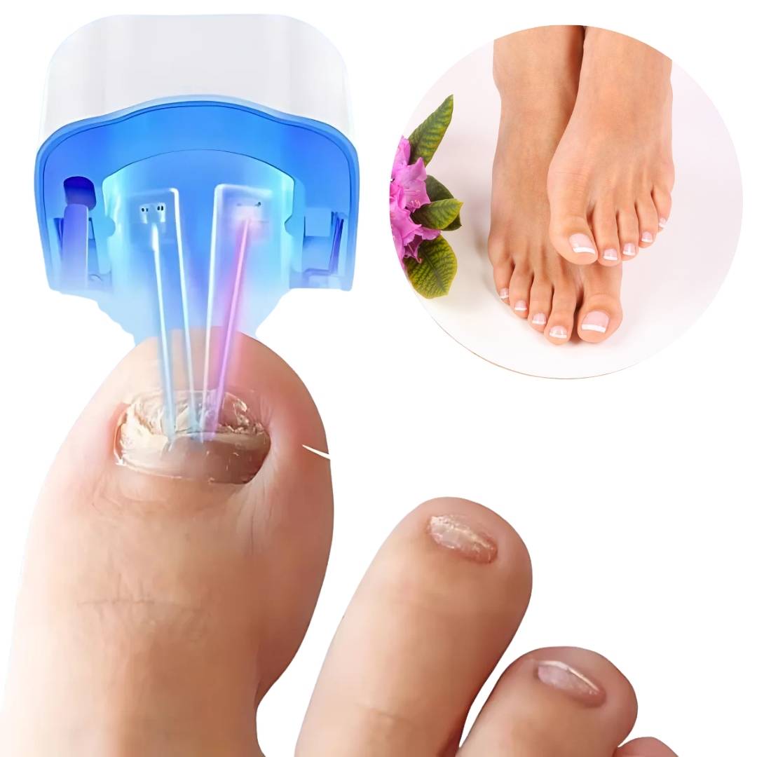Nagelpilz-Lasergerät ClearNagel Pro – Schmerzfreie und effektive Behandlung für gesunde Nägel mit fortschrittlicher Laser-Technologie 1