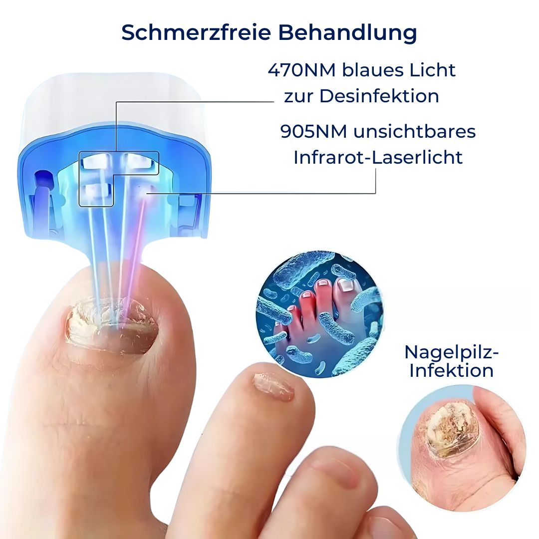 Nagelpilz-Lasergerät ClearNagel Pro – Schmerzfreie und effektive Behandlung für gesunde Nägel mit fortschrittlicher Laser-Technologie 4